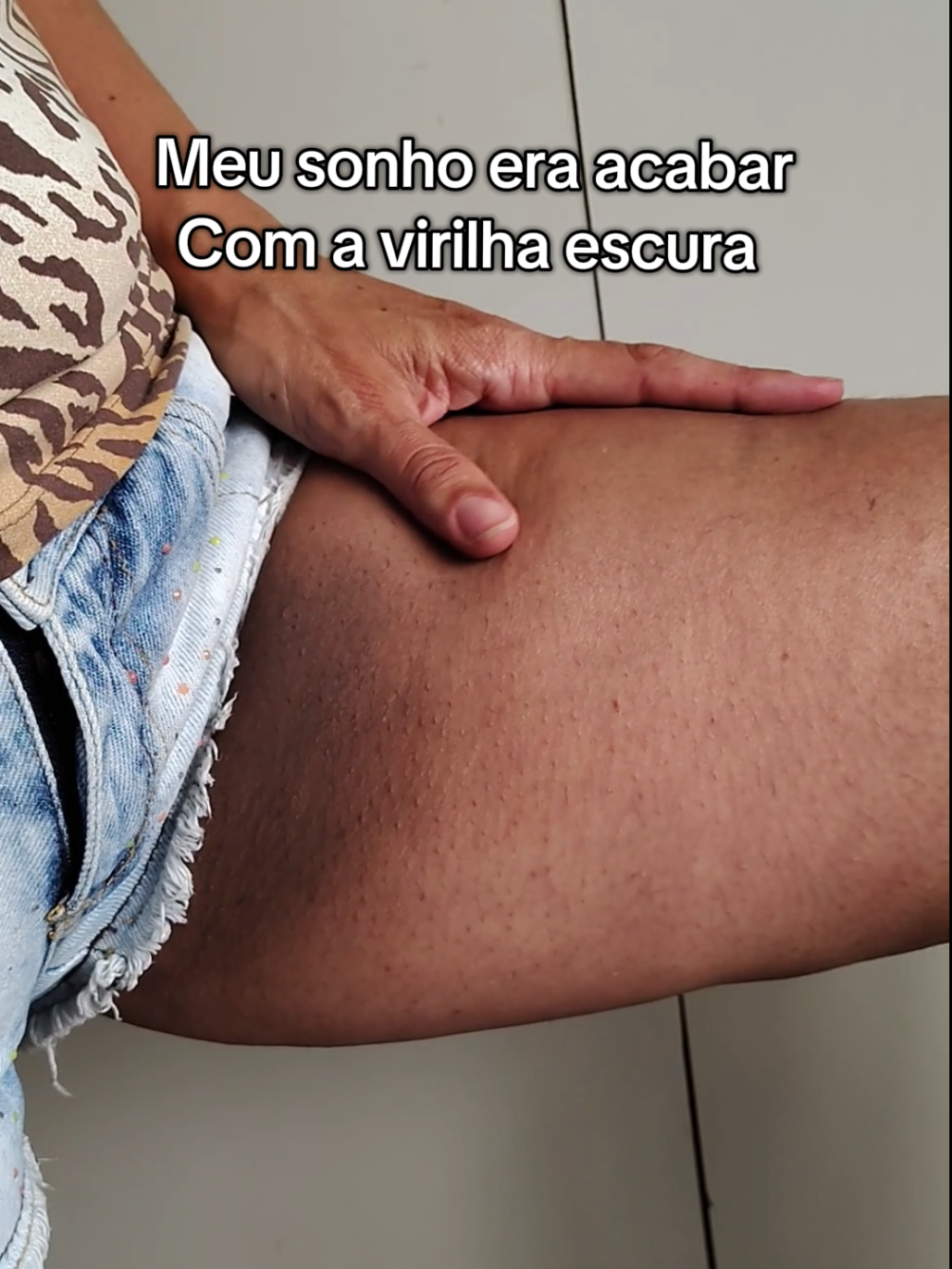 era meu SONHO minha virilha deixar de ser escura #clareador #clareadordemanchas #manchas #virilhas #fyp 