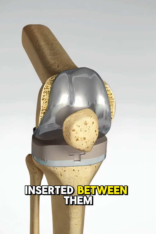 Total Knee Replacement Surgery  #kneereplacement #kneereplacementsurgery #kneesurgery #kneearthritis #kneejointreplacement #kneereplacementrecovery #medical3danimation #3dmedicalanimation 