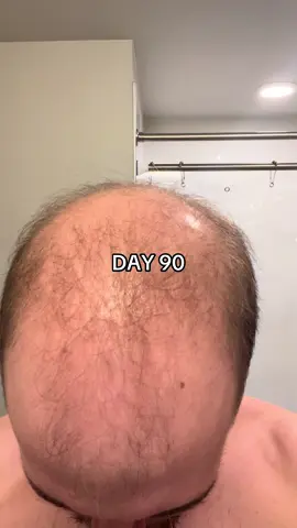 At 18 I still had a full head of beautiful hair. Nothing showed any signs of loss coming soon. But once I turned 19, I noticed a significant change and heavy shedding. I embraced it because everyone around me kept saying it’s genetics and there’s nothing I could do. At 20, I even visited a trichologist who suggested pills and topical minoxidil. I tried them for a few months, but I wasn’t tracking my results and saw no difference. I didn’t take it seriously and just kept accepting it. At 22, things changed. I decided to overhaul my health because of severe facial acne. After finally figuring that out and clearing my skin, I thought, why not try the same with my hair? Now I’m 23, and even though my Norwood is at 7, I decided to give myself a real shot. For almost 50 days now, I’ve been consistent with a fully natural routine. I’m not planning to give up. I’ll keep going for the next 6–8 months, tracking everything daily and sharing it with you here. I want to prove to myself (and maybe to others) that even with my condition, improvement is still possible. Let’s see what happens together.