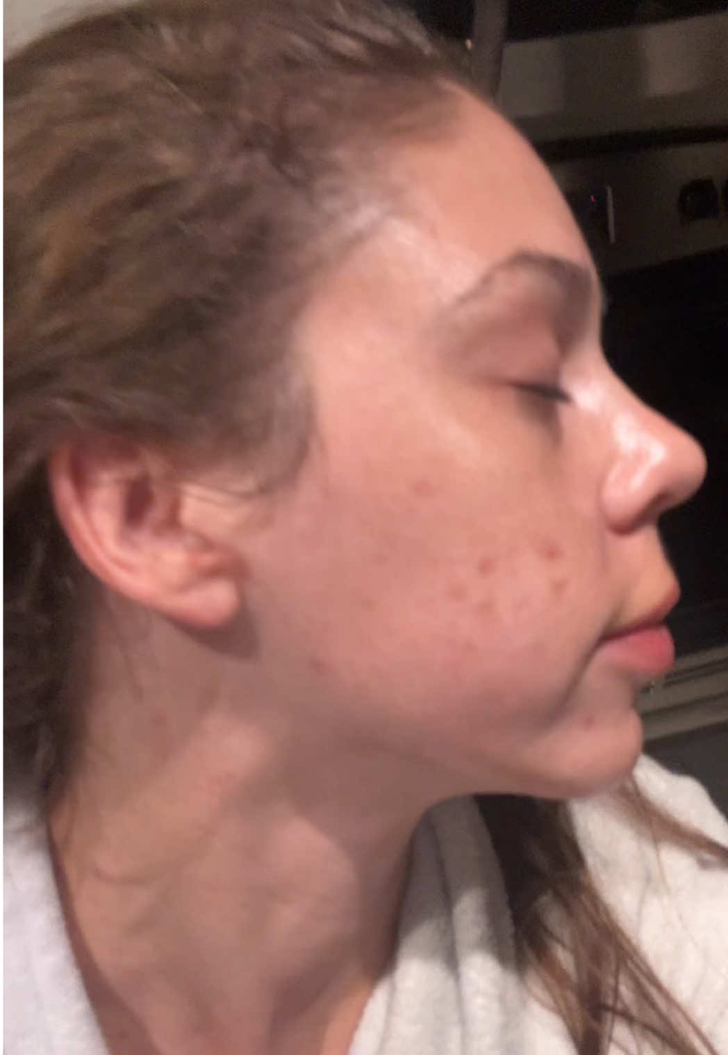 Day 17 of no picking #acne #chemicalpeel #face