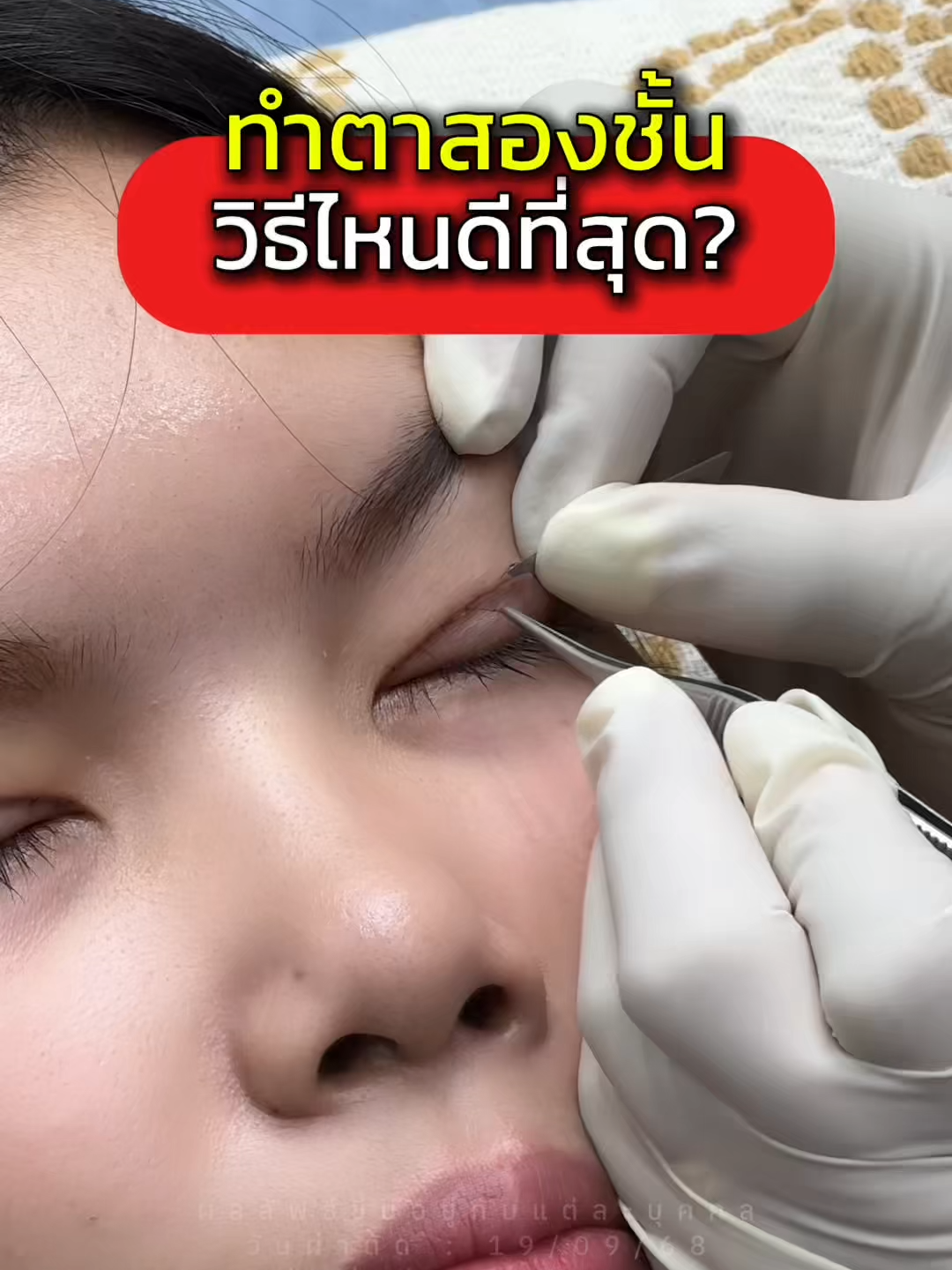 ทำตาสองชั้นวิธีไหน ดีที่สุด? #ตาสองชั้น #jewelryeyeตาสวยสดใสเปล่งประกาย