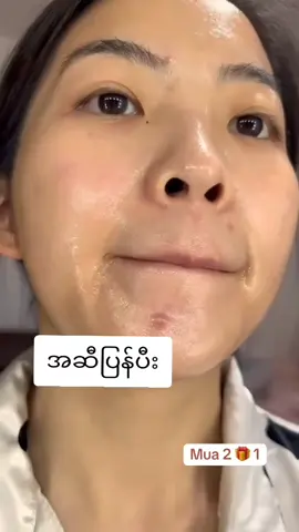 #သဲသဲ #ဝက်ခြံ၊အမဲစက်ပျောက်ချင်သူများအတွက် #မသိသာရင်ငွေပြန်အမ်းမယ်ကွာ #မန်းလေး #fpy 