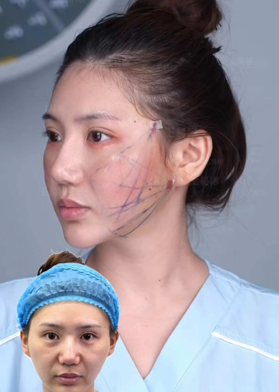 ✨ 9D Facelift: From Heavy to Heavenly Too much filler or sagging skin doesn’t have to define your look. With 9D, we reduce volume, tighten skin, and lift contours — all in one session. The result? A natural, youthful, radiant face that turns heads everywhere you go. 💖 #9DFacelift #FacialRejuvenation #GlowUp #SkinTightening #FacialLiposuction     