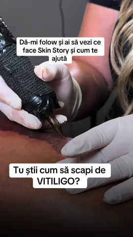 După mulți ani ,acum poți scăpa de Vitiligo. Cum?  Prin camuflare paramedicala. Așa cum vezi în clip . #SkinStory #camuflagemvitiligo #Dermopigmentare #CamuflareVitiligo #camuflajvitiligobucuresti 