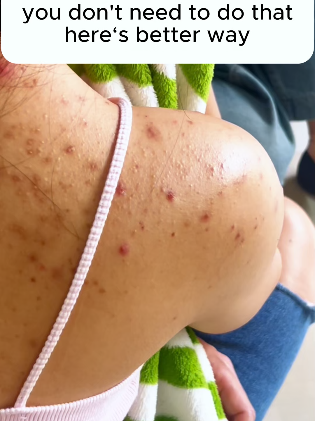 you don't need to do that here's better way#backacne #bacne #acneskin #bodyacne #bodywash #bodycare #skincare #smoothskin #sulfur #mite #acnetreatment