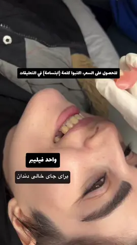 فيليبر متحرك، ولكن عند الاستخدام يظل ثابتًا وآمنًا! تحتاجون إلى جلسة واحدة فقط لأخذ القالب، وسيتطلب تحضيره من ثلاثة إلى أربعة أيام عمل، ثم يمكنكم الحضور لاستلامه 🌸🙏 يمكن استخدام الفيليبر حتى الأسنان رقم 6، ولكنه غير مناسب للأسنان رقم 7 وما فوق. يمكن استخدامه لتعويض من سن واحد إلى ثلاثة أسنان مفقودة 🌸 (أما في حالة فقدان عدد كبير من الأسنان، يتم استخدام جهاز 