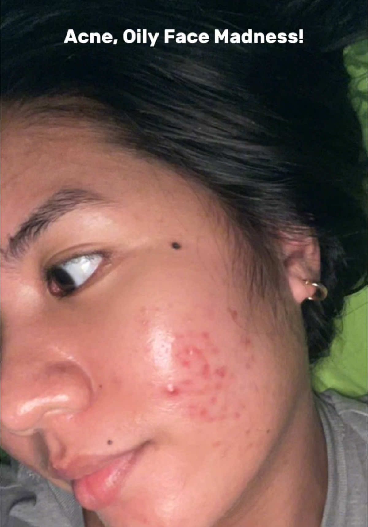 No more Oily Skin and Acne✨🩷 #mugwortclaystick #acneprone #oilyskin #g2gmugwortclaymask #g2gph 