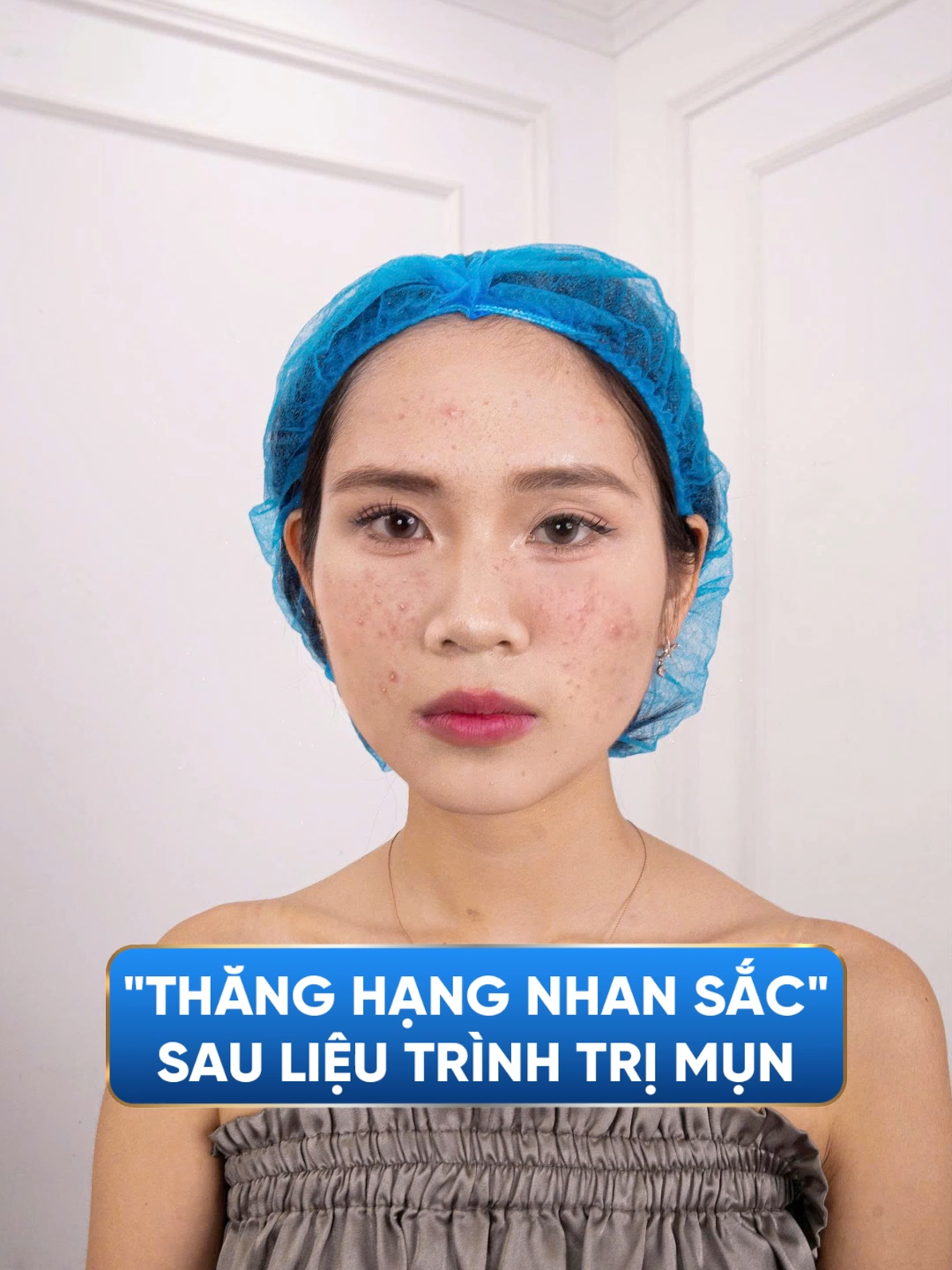 Hành trình từ mụn viêm sưng đỏ đến làn da sáng mịn, khoẻ mạnh ✨ Đặt lịch soi da cùng bác sĩ để biết lộ trình phù hợp cho bạn. #pgstrandangquyet#mun#dieutrimun#beforeafter#xuhuong#chamsocda