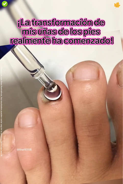 ¿Uñas feas? Puede que no sea un problema tan pequeño...#nailcare #toenails #nails #tiktokshop #fallfreshness 