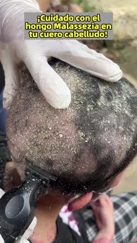 If you have oily hair and dandruff, try this selenium disulfide shampoo. It's very effective at controlling oil and eliminating dandruff. #antidandruffshampoo #antidandruff #haircare#shampoo#dandruffremove