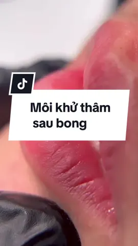 Mụt chiếc cam thường MÔI KHỬ THÂM sau bong màu đã ổn định. Chân thật đến từng lỗ chân lông  #dalat #dalatbeauty #phunxam #khuthammoi #phunmoidep                       