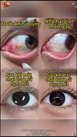 Kem Dưỡng Ẩm Mắt, Dưỡng Ẩm Lâu Dài, Thích Hợp Cho Người Dùng Máy Tính / Học Sinh, Nhẹ Nhàng, Không Kích Ứng