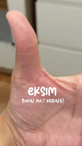 Kalau kamu lagi struggle sama eksim, stop scrolling! 🚫 Aku nemu cream yang bener-bener bantu regeneration kulitku. Hasilnya? No more kering & gatal parah! ✨ #wundplus #regenerationcream #eczema #eksim #kulitkering 