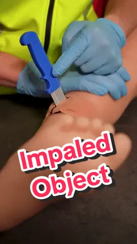 First Aid on an Impaled Object 🚑🩸 ⚠️ Never pull out an impaled object! Removing it can cause severe bleeding and more internal damage. 👉 Quick demo in this video: I use a bag filled with colored liquid and pull out a pen – the “bleeding” shows why you must leave the object in place. ✅ What to do instead: 1️⃣ Place sterile gauze on both sides of the object. 2️⃣ Add rolled bandages left and right to stabilize it. 3️⃣ Wrap another bandage around everything until secure. 🔒 This keeps the object from moving. 🚑 Always call emergency services and let doctors remove it safely in the hospital.