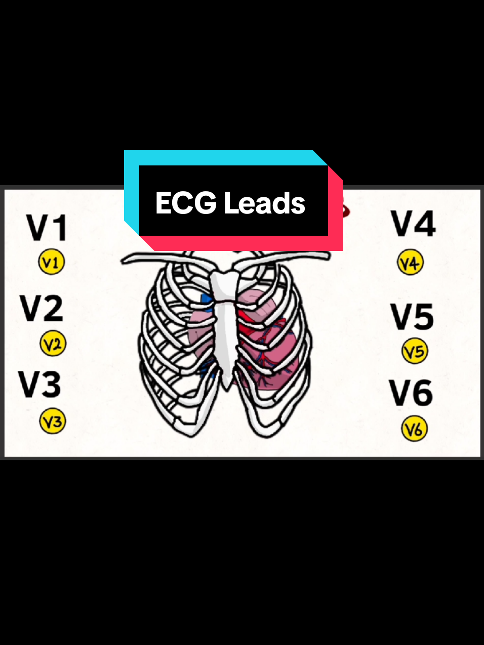تنسو الإشتراك بقناتنا على يوتيوب Mamado's Medical Media ECG Leads Explained | Limb & Chest Leads شرح فسيولوجي مبسط مع د.عبدالعزيز علاء الدين  Electrocardiography (ECG) records the electrical activity of the heart 🫀 using different leads: Bipolar limb leads: I, II, III between body limbs. Unipolar limb leads: aVR, aVL, aVF. Chest (precordial) leads: V1 to V6, providing a 3D electrical view of the heart. 📜 History of ECG: Discovered by Willem Einthoven in the early 20th century, awarded the Nobel Prize in 1924. 🖥️ Modern ECG: Digital, accurate, and essential for both routine and emergency diagnosis. --- #ECG  #Electrocardiography  #Cardiology  #MedicalStudent  #MamadosMedicalMedia #MedSchool  #رسم_القلب  #تخطيط_القلب   #طب_بشري   #شروحات  #طلاب_طب #طب  #fyp 