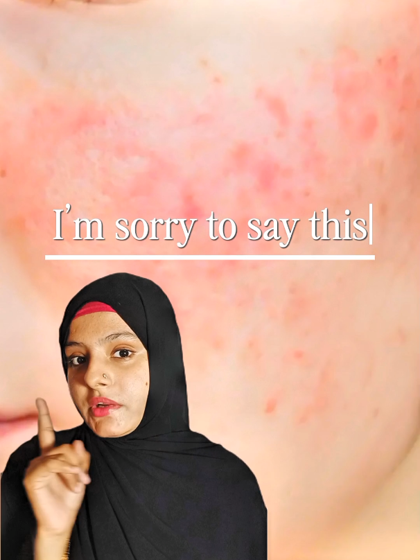 If your skin barrier is damaged, no product will work the way it should 💔 That’s why I tried Hydrobase Ointment by @Neophar Skin Sciences 🩵 . A simple, affordable skin barrier repair cream with white soft paraffin. After 1.5 months, my skin feels calm, hydrated, and healthy. The best budget skincare in Pakistan for dry and sensitive skin. #skinbarrierrepair #barrierrepair #healthyskin #dryskinsolution #budgetskincare 