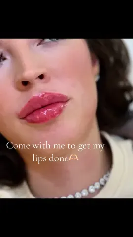 Come with me to get my lips done by Beauty & Aesthetics by Bonnie in Norwich🫶🏻 #fyp #lipfiller #comewithme #beautyandaesthetics 