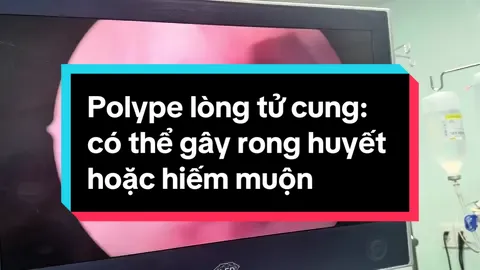 Polype lòng tử cung có thể là nguyên nhân gây rong huyết và hiếm muộn. #phunuvuikhoe #bslengocdiep #polype 