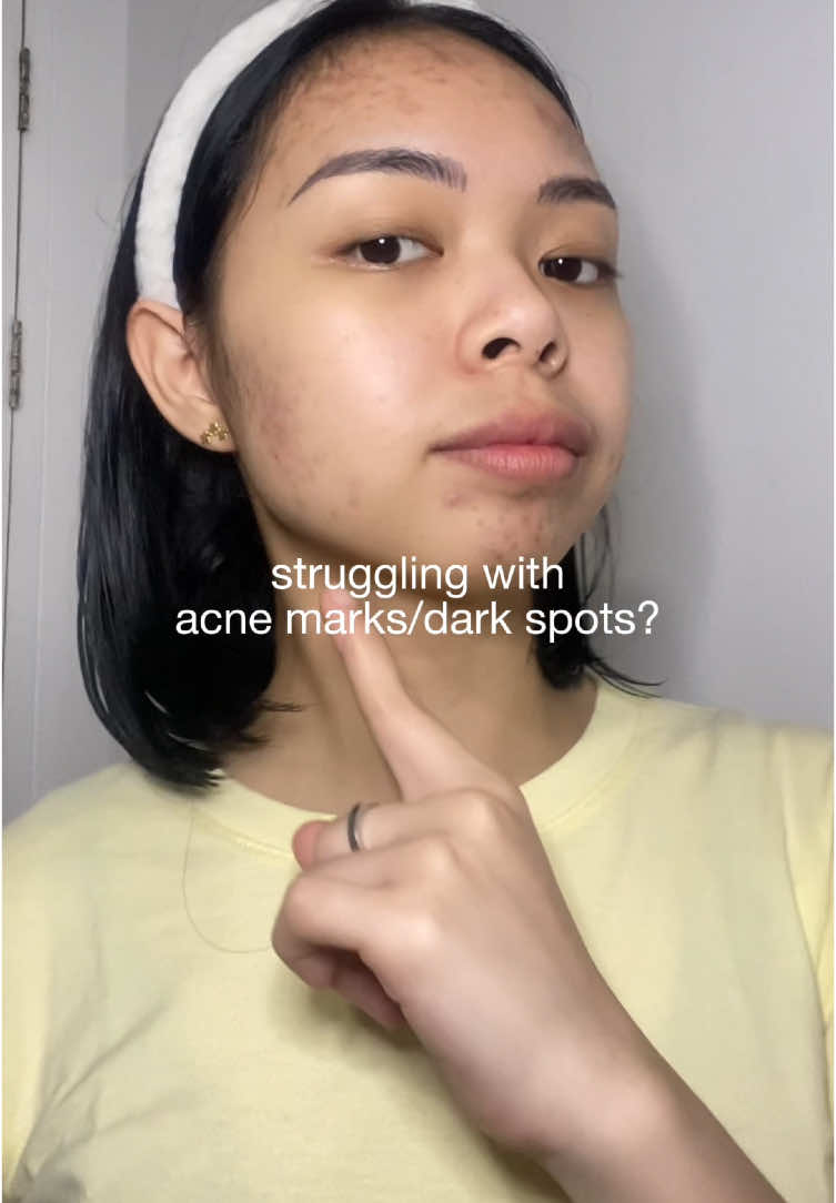 Brighten up your face in just 3 days?! Only @garnierph can do that!✨ #skincare #GarnierCBrighter #GarnierCFaster #GarnierGang #acnefighter #acneproneskin #acnemarks #fyp 