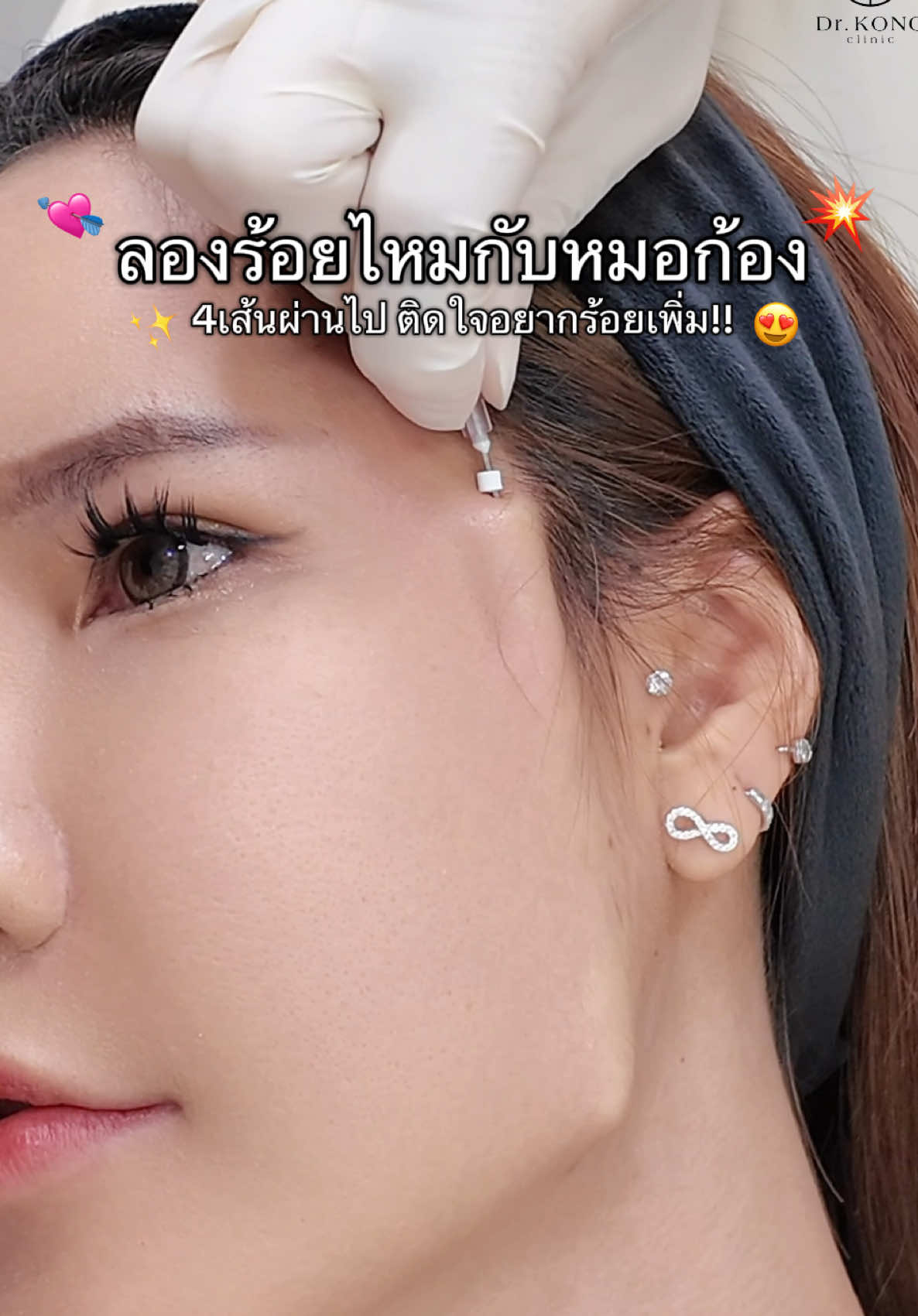 ติดใจร้อยไหม 4เส้นไม่พอต้องเพิ่มแล้วค่ะ 🤣💘✨  #ร้อยไหม #ร้อยไหมยกกระชับ #รีวิวบิวตี้ #หน้าเรียว 