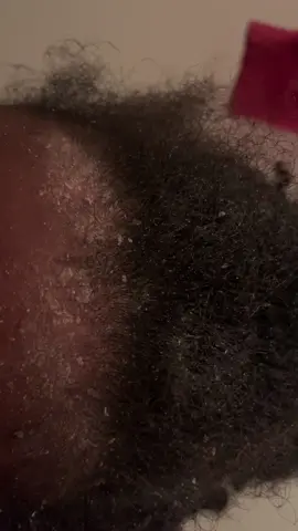 Hello everyone, I have psoriasis all over my body but it gets really bad on my scalp, nose and behind my ears. If I don’t keep up with it like moisturizing thoughout the day or washing my hair, it will flake up like this and cause my scalp to get lighter or hair loss. I just want to start posting my scalp scratches to share with people and hopefully bring enjoyment with these videos, because I too, love to watch dandruff scratching videos. I just wanted to share a little something about me, thanks for watching!😊🩷✨#psoriasis #foryoupage #fyp #dandruffremovel #scalppsoriasis 