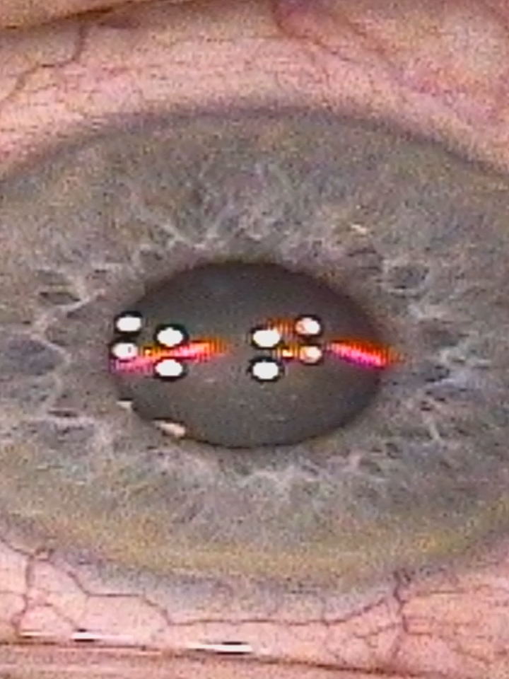 Whenever we do surgery we alwasy start with the right eye and then move to the left. Here, our patient had a radial keratotomy procedure that left spokes around the eye and eventually led to those spokes wearing over time. Those spokes were meant to improve the vision. Now, with topographic guided ablation we take the map of a cornea and reshape it to enhance the vision and creating lasting effects to avoid repairs in the future. . . . . #eyesurgeon #cornea #lasikeyesurgeon #lasiksurgeon #laser #lasik #lasersurgery #eyes #vision #sandiego #blurredvision #astigmatism #astigmatismo #eyesight #eyecare #eyetreatment #keratoconus #prk #keratoconusawareness #crosslinking