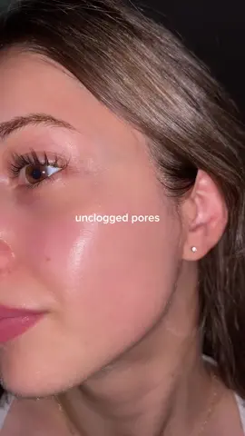 azelaic acid lover forever 🫶 #azelaicacid #anua #cloggedpores #clearskin #koreanskincare 