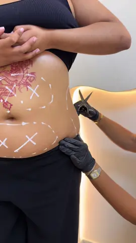 ❄️ OFFRE CRYOLIPOLYSE DE FOLIE ❄️ Tu veux dire bye bye aux petits bourrelets ? C’est LE moment 🔥 ✨ 4 zones à seulement 120€ (au lieu de + de 300€, oui tu as bien lu 😱) Résultat ? Une silhouette affinée, sans effort, sans douleur, et sans chirurgie 💁‍♀️ Et comme on est en hiver, ton corps a tout le temps de s’affiner en douceur avant l’été 🌸 📍 Nous sommes disponibles dans les villes suivantes : Asnières-sur-Seine • Aulnay-sous-Bois • Choisy-le-Roi • Pantin • Montpellier • Lyon 📲 Réservation au 06 81 95 42 87 Attention, les places sont limitées ! Ne laisse pas passer cette opportunité 💥 #fyp #cryolipolyse #bodyindustry #offrecryo #laser 