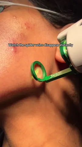 @Dr. Rishi Chopra, MD took this rly cool video after v beaming some acne spots, we also decided to target the spider veins 🕷️ #laserskincare #vbeam #spiderveins #acnetreatment #browngirlfriendly 