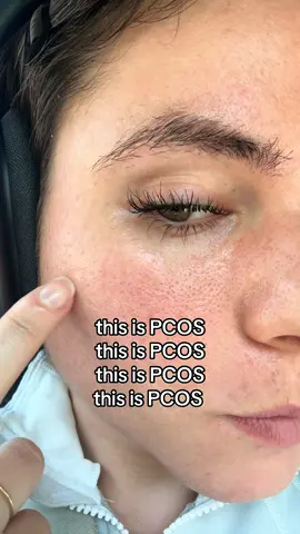 PCOS is a chronic hormonal disorder that can be driven by too many male hormones. These are called your androgens. When androgens are high in women it can cause PCOS symptoms like: 1) large pores  2) hair loss  3) excess face and body hair (hirsutism) 4) quick muscle growth & athleticism 5) irregular periods These are some of the symptoms I experienced and they should not be ignored. #pcos #pcosawareness #pcosproblems #pcoslife #hormoneimbalance 
