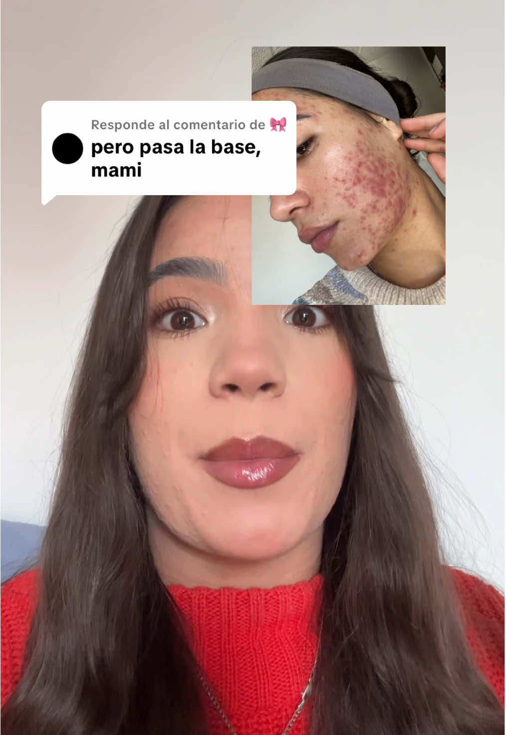 Respuesta a @🎀 esta es la base que usó y así es como cuido mi piel con acné activo #acne #acnetreatment #acnefighter #clinique 