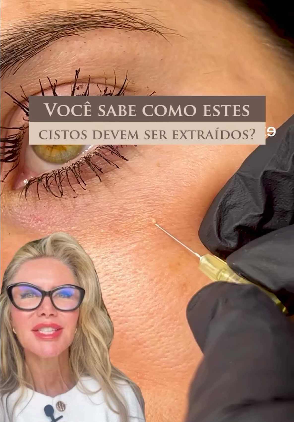 Você sabe o que é milium? ⚜️ Milium é uma bolinha branca que aparece na pele, especialmente no rosto e que muitas pessoas confundem com cravos. Ele surge devido ao acúmulo de queratina e não deve ser removido manualmente em casa. ⚜️ Tentar espremer pode causar lesões, infecções e até cicatrizes, já que o milium está preso sob a pele e exige uma abordagem técnica para ser retirado. ⚜️ A extração segura do milium deve ser feita por um profissional qualificado, com o uso de agulha estéril, luvas e técnica de assepsia para evitar complicações. Esse procedimento é simples, mas precisa ser realizado com cuidado para garantir que não haja danos à pele. ⚜️ Para prevenir o surgimento dessas bolinhas, é importante adotar alguns hábitos na rotina de cuidados. A esfoliação da pele, feita de uma a duas vezes por semana, ajuda a remover o excesso de células mortas e a evitar o acúmulo de queratina. Além disso, o uso de produtos à base de ácido salicílico ou ácido glicólico durante a noite favorece a renovação celular, o que também contribui para a prevenção. Você já tinha ouvido falar sobre milium? Ou já tentou tirar em casa? #skincare #cuidadoscomapele #milium #beleza #estetica limpezadepele      