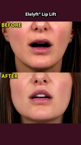 Here are our patient’s results from her Elelyft®️ Lip Lift after 3 months! She is loving how they are looking so far! What do you think?  #lipliftnyc #liplift #beforeandafter #plasticsurgeonnyc 
