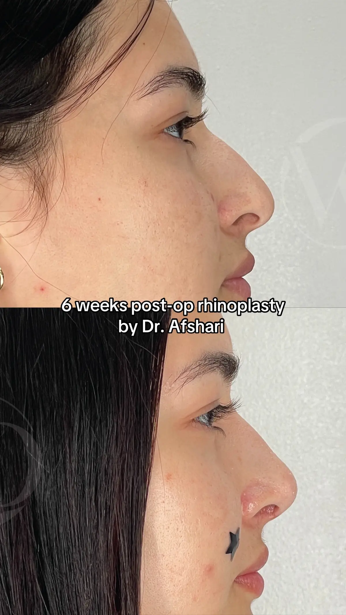 Natural rhinoplasty results 💫😍 Our beautiful 18-year-old patient is just 6 weeks out from her rhinoplasty with Dr.Afshari. A refined profile that still feels authentically her ❤️ #rhinoplasty #nosejob #surgery #fypシ #surgerytiktok 
