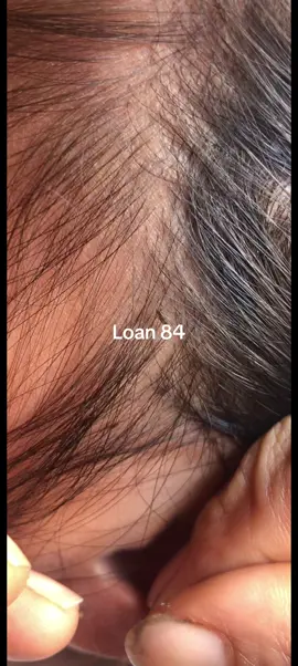 lice removal ##omg😱😱 #lice #trending 