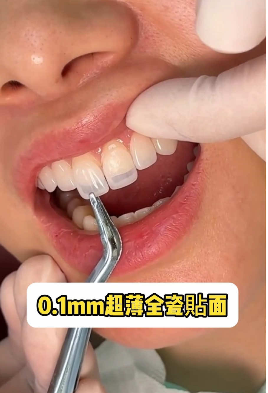 哇！真的好漂亮的一口牙😍 #牙貼面 #全瓷貼面 #台北 #牙齒美容 #牙齒黃 