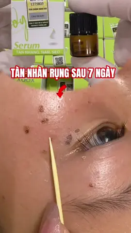Chấm rụng tàn nhang dau 7 ngày tại nhà ☘️#tannhang #chamtannhang #peeldatainha #Peel_da 
