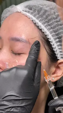 Tiêm làm đầy thái dương, cải thiện tình trạng hóp giúp khuôn mặt hài hoà hơn 🥳🥳 #fillers💉 #FillerUyTin #haiphong #Tiêmfiller #haiphongphoto 