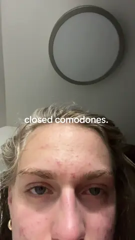 #acne #closedcomodomes #acnescars #acneproneskin #pimples 