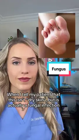 Athlete’s foot is a fungal infection that typically appears as itchy, red, peeling, or cracked skin between the toes or on the soles of the feet. To treat it, keep your feet dry, use over-the-counter antifungal creams or sprays, and wear breathable shoes #dryfeet #athletesfoot #tineapedis #medical