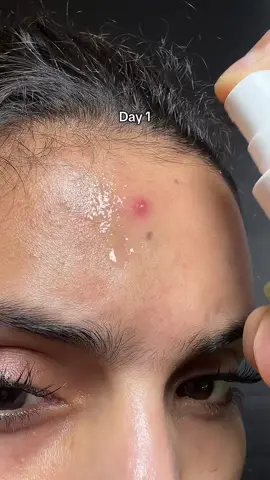 Soothing and healing acne spray #kbeautyblogger #fyp #koreanskincareproducts #acnespray #orien 