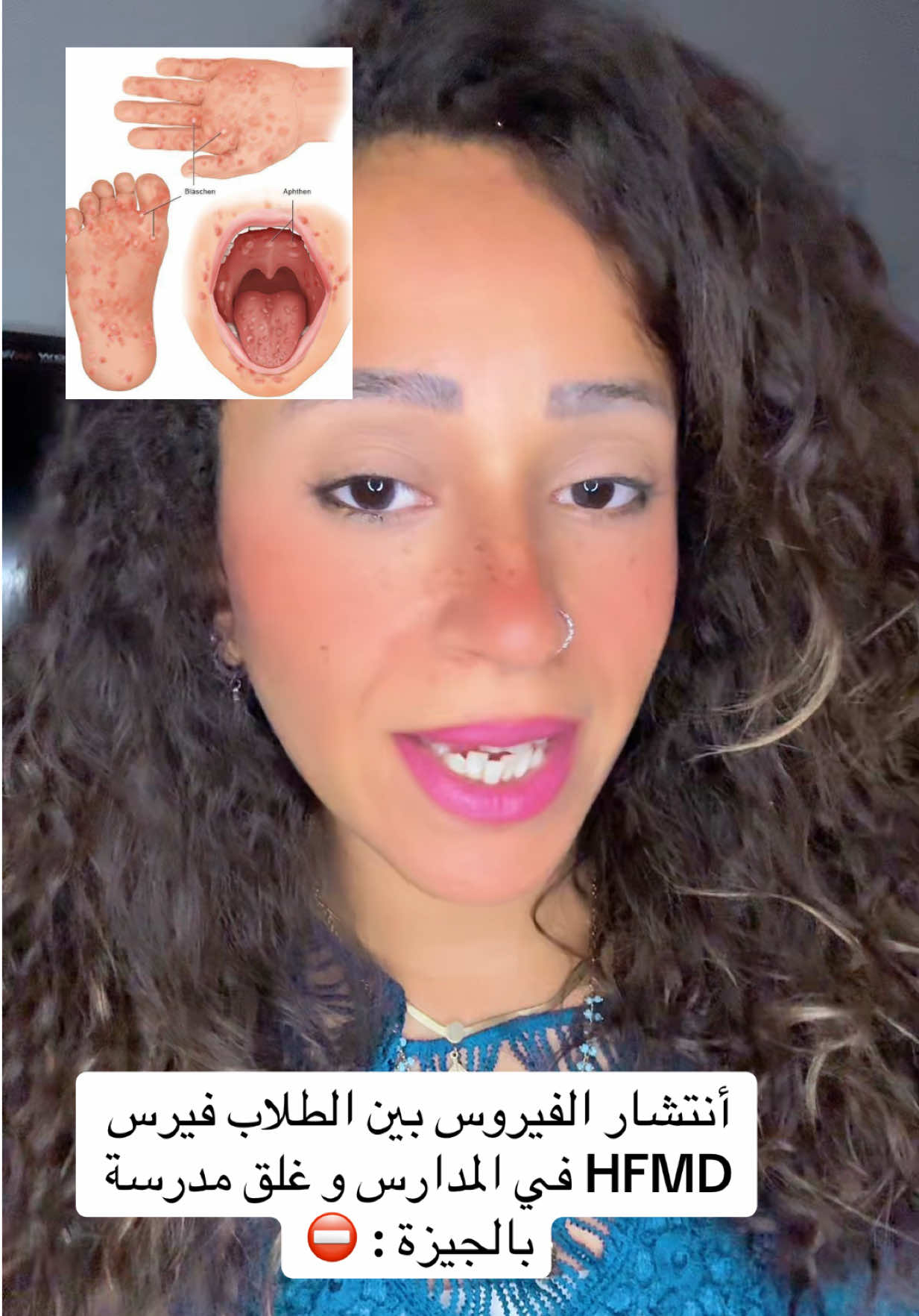 أ ن ت ش ا ر الفيروس بين ال ط لا ب فيرس HFMD في ال م دا ر س و غلق م د ر س ة بالجيزة : ⛔️ #judyseddik #hfmd #انتشار_فيروسي #المدارس #جودي_صديق 