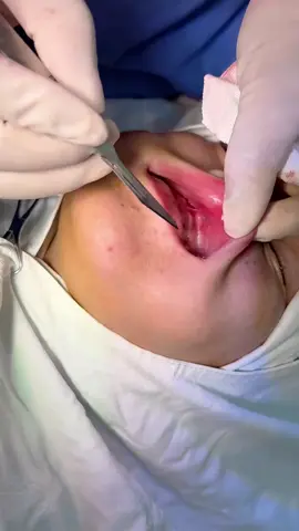 鼻基底凹陷（depression of the nasal base）  #变美技巧 #鼻基底凹陷 #鼻基底 