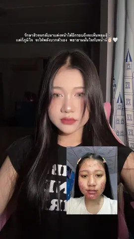 เก่งเเล้ว✌🏻🥺 #รักษาสิว #หลุมสิว #ดูเเลต่อไป 