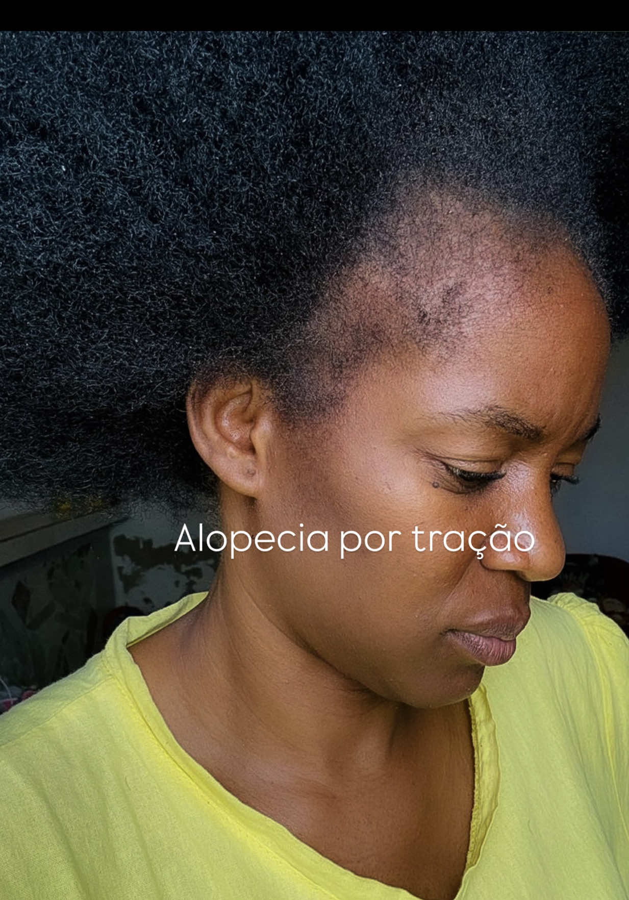 Antes & Depois ✨ Nossa cliente tinha alopecia por tração (quedas por tranças apertadas). Com o nosso tônico, o cabelo voltou a nascer forte 🥹🩶  #CrescimentoCapilar #wafygirl #alopeciaportracao #angola #viral 