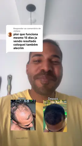 Respondendo a @Juliano  #fyppppppppppppppppppppppp #fyp #quedadecabelo #crescimentocapilar #calvicie 