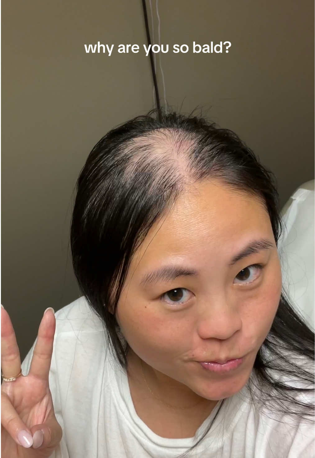 had to use this audio lol  #bald #alopecia #alopeciaareata #hairloss #hair #hairjourney #telogeneffluvium #alopeciaawareness 