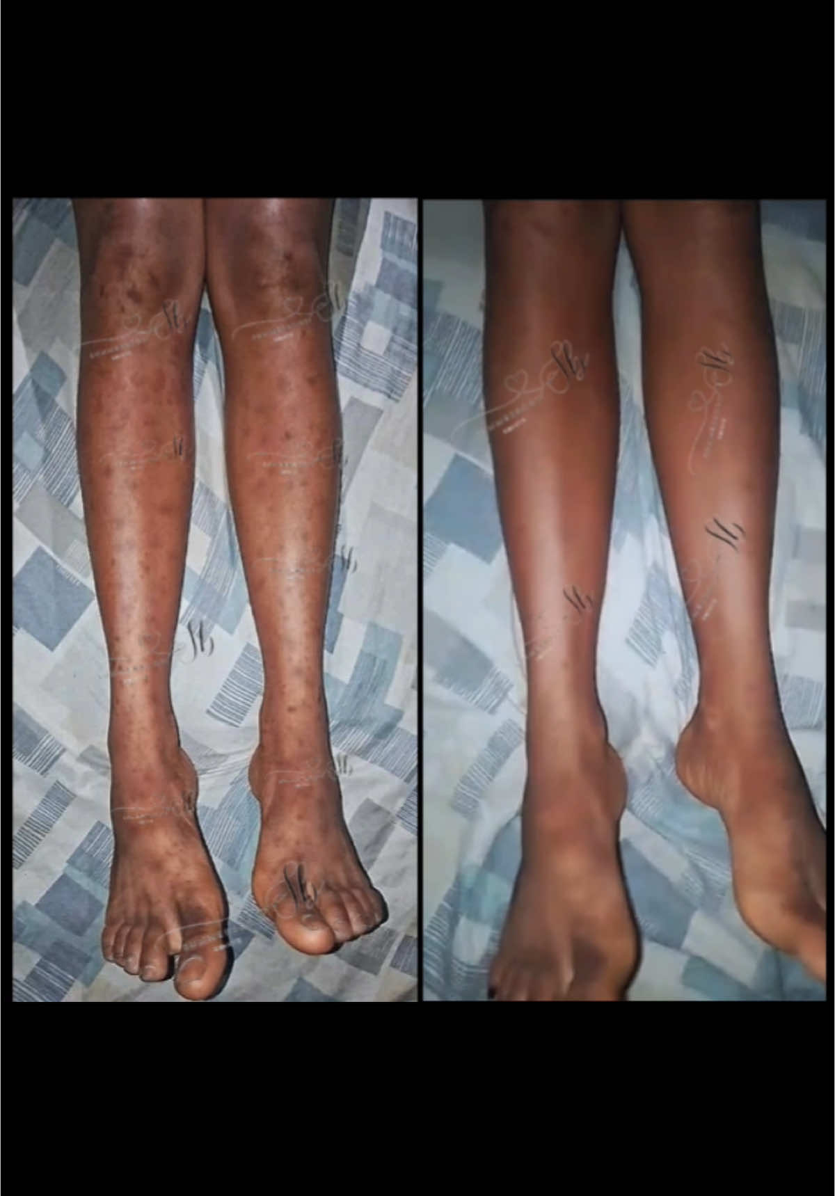 Quand je dis que Summerbody est le meilleur, eh bien maintenant vous pouvez voir pourquoi 😘😘💃🏽😘 Jambe noirs eliminer les taches noirs  produit anti-taches  tache noir sur le corps  enlever les taches sur piEd hyperpigmentation  Tache jambe  #hyperpigmentation #tache #cicatrices  #tachesbrunes #darkspots #scar 