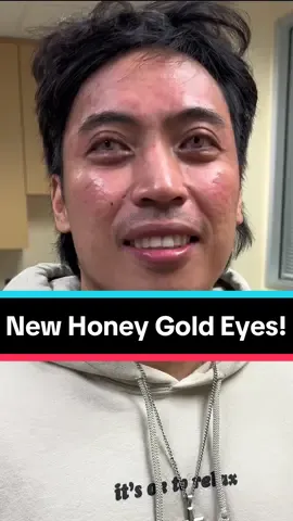 Beautiful Honey Gold eyes! The ColorEyes procedure has a 16-year track record of overall high safety (if it wasn’t safe then I wouldn’t be performing it). It is not an implant but uses specialized ink made for the cornea to change eye color in 15-20 minutes per eye. There are different levels of intensity - low, medium, or high. It’s an easy trip to our Beverly Hills office to have the eye color you’ve always wanted. More information at MyColorEyes.com #coloreyes #keratopigmentation #eyecolor #eyecolorchange #flaak