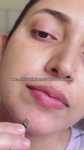 Rael Miracle Pimple Patch Bundle of 4 @Rael #pimplepatch #acnepatch #skincare #fyp #tiktokviral 